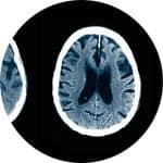 Mild Cognitive Impairment